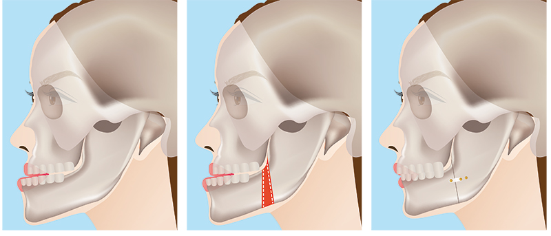 Resultado da cirurgia ortognática em paciente com prognatismo